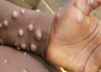 CACAR MONYET: IDI Keluarkan Rekomendasi di tengah Urgensi