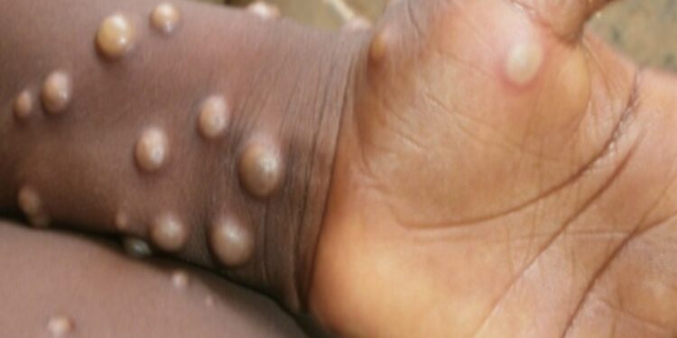 CACAR MONYET: IDI Keluarkan Rekomendasi di tengah Urgensi