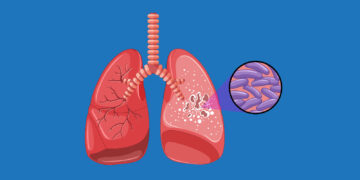 Eliminasi TBC Terganjal Anggaran?