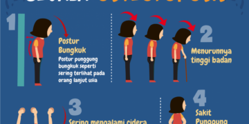 Pernah Patah Tulang Berisiko Terkena Osteoporosis, Simak Gejala Osteoporosis Lainnya