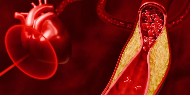 Penyebab dan Faktor Risiko Dislipidemia, Berhentilah Merokok